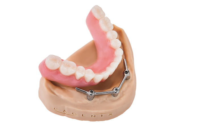 AccuFrame Overdenture 3